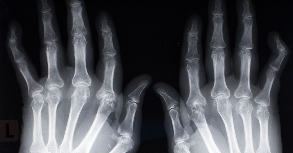 Severe joint erosion - hands